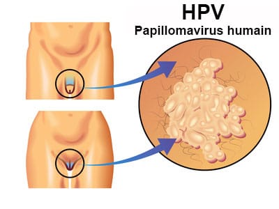 Vaccin contre la papillomavirus : campagne soutenue par le PLFSS 2024