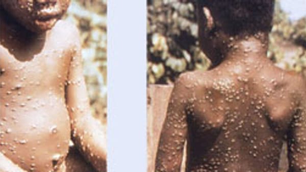 Variole du singe : le G7 lance une simulation mondiale, l’armée US fournit le vaccin