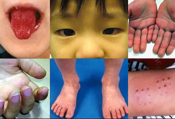 Durant le Covid, le syndrome de Kawasaki a diminué… contrairement à ce que la presse affirmait