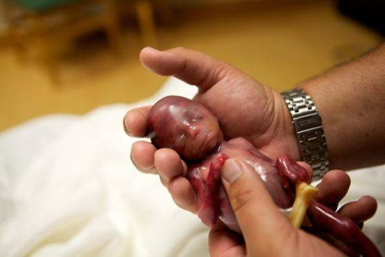 Avortement : que dit vraiment l’arrêt de la Cour Suprême aux USA ?