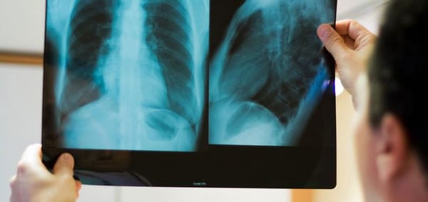 Tuberculose : inquiétante hausse des cas en France