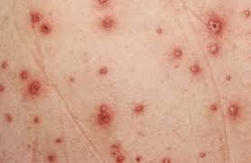 La HAS complète sa doctrine sur la vaccination des soignants