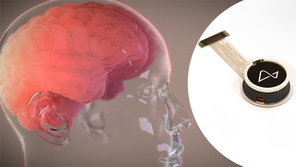 Neuralink : un patient paralysé parvient à communiquer grâce à un implant cérébral