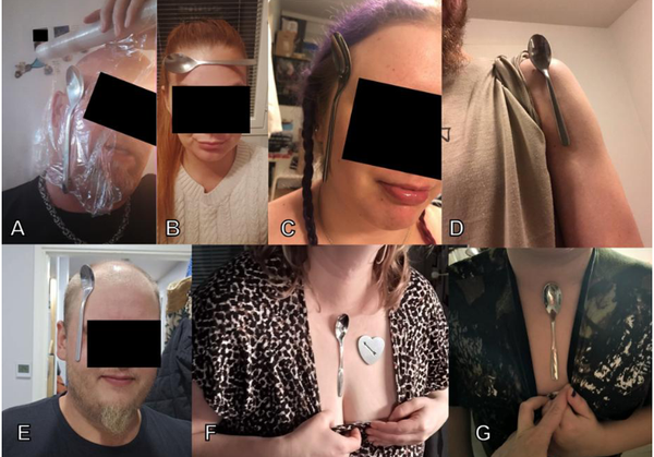 Une étude révèle des cas inquiétants de magnétisme post-vaccin COVID-19