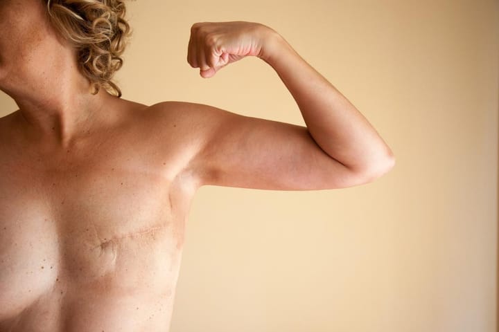 Mais à quoi peut bien être due l'explosion des cancers du sein chez les jeunes ? par Veerle Daens